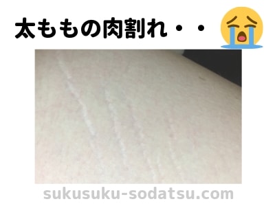 肉割れが気持ち悪い 少しでも薄くする 目立たなくする3つの方法 ままやすみ